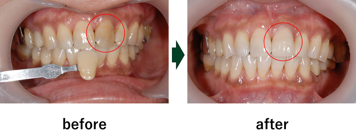 【症例】ホワイトニングとジルコニアセラミックを併用した前歯の審美治療