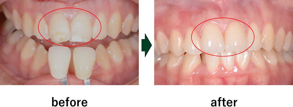 【症例】エナメル質形成不全への対応