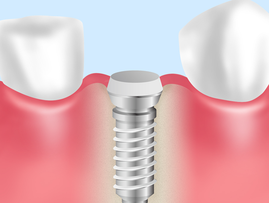 STEP4：歯ぐきの切開（2回目の手術）