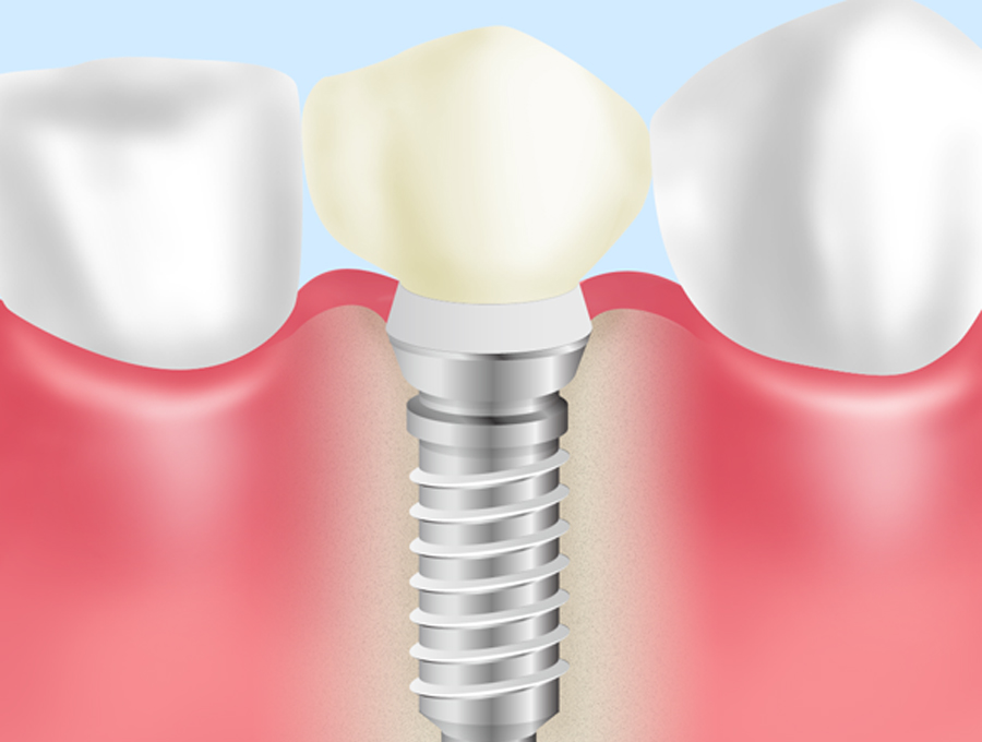 STEP5：人工歯の装着
