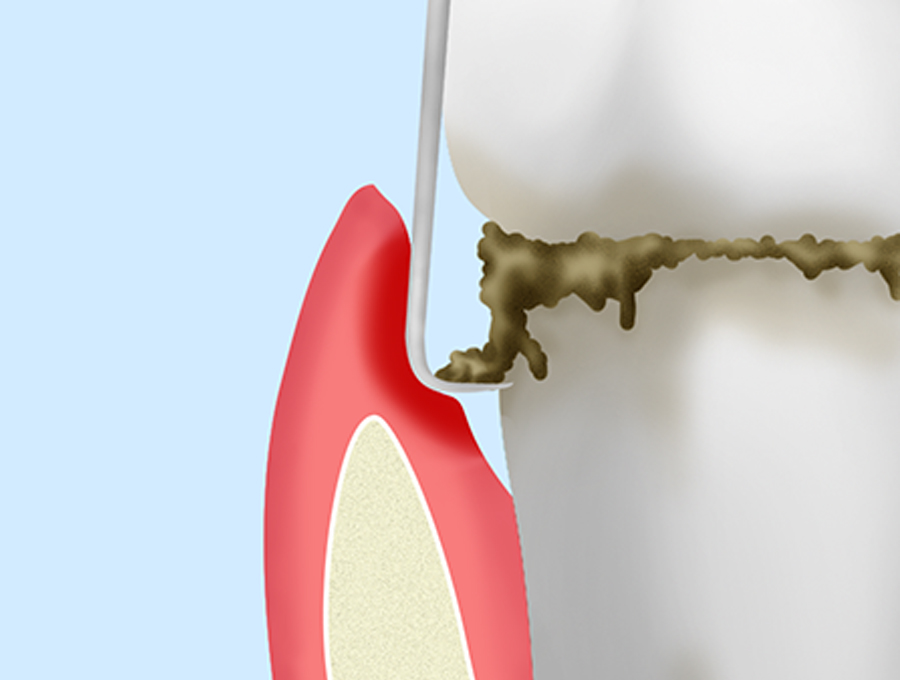 歯周ポケットそうは術