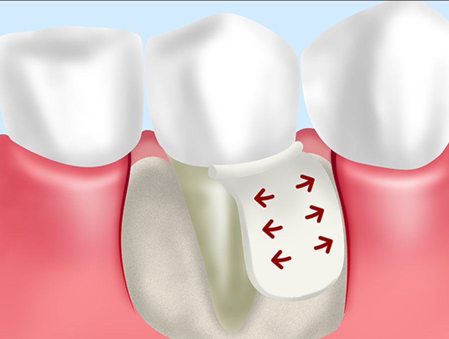 組織誘導再生療法（GTR法）