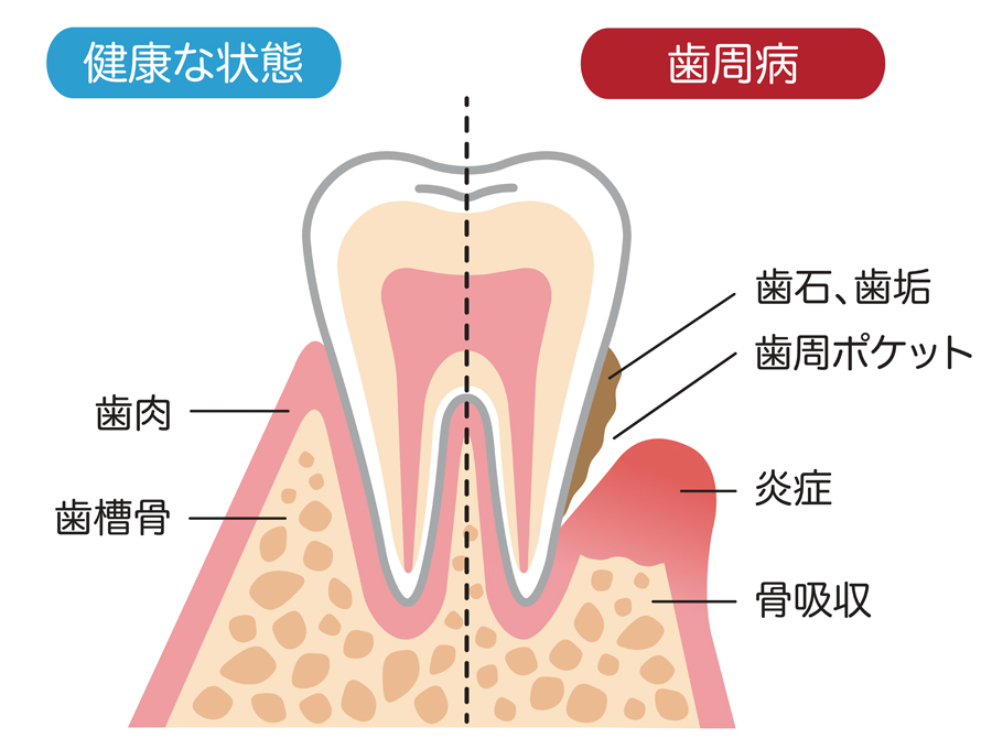 歯周病とは