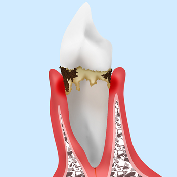 【軽度歯周炎】