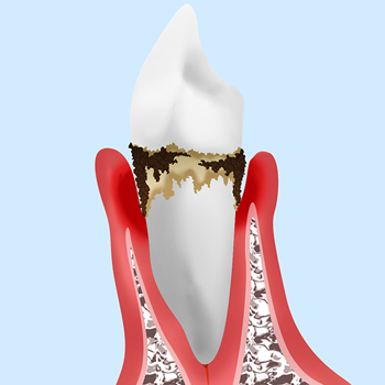 【中等度歯周炎】