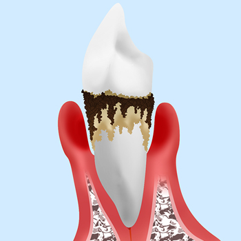 【重度歯周炎】