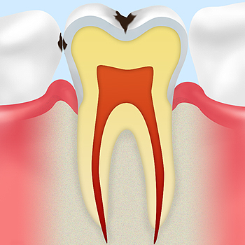 【C1】エナメル質のむし歯