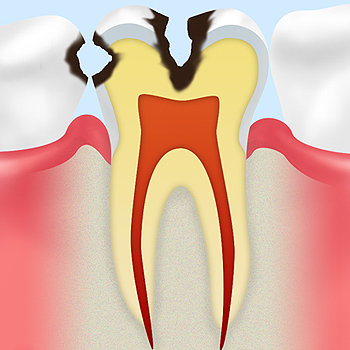 【C2】象牙質のむし歯