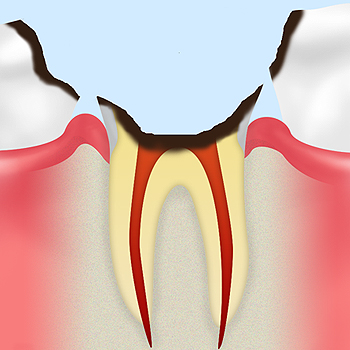 【C4】歯根に達したむし歯