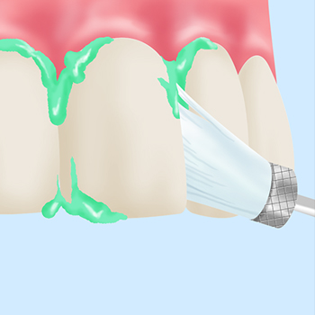 Step1：ご説明と歯のクリーニング