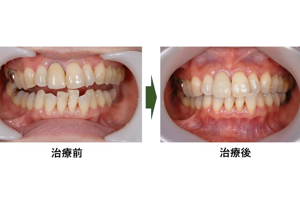 【症例】黒ずんだ歯茎の改善を図った審美修復