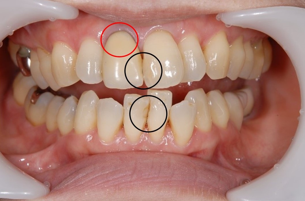 【症例】黒ずんだ歯茎の改善を図った審美修復