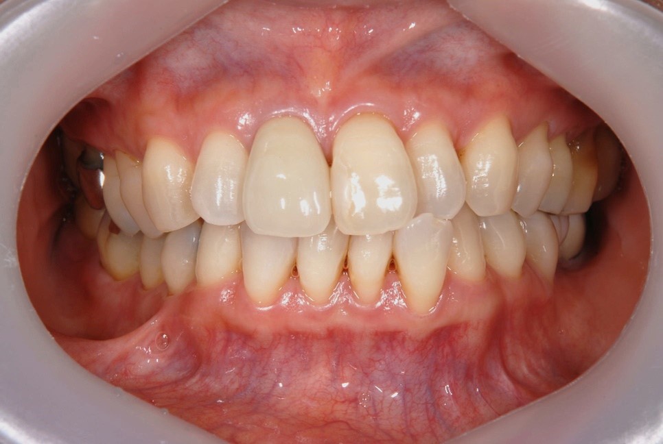 【症例】黒ずんだ歯茎の改善を図った審美修復