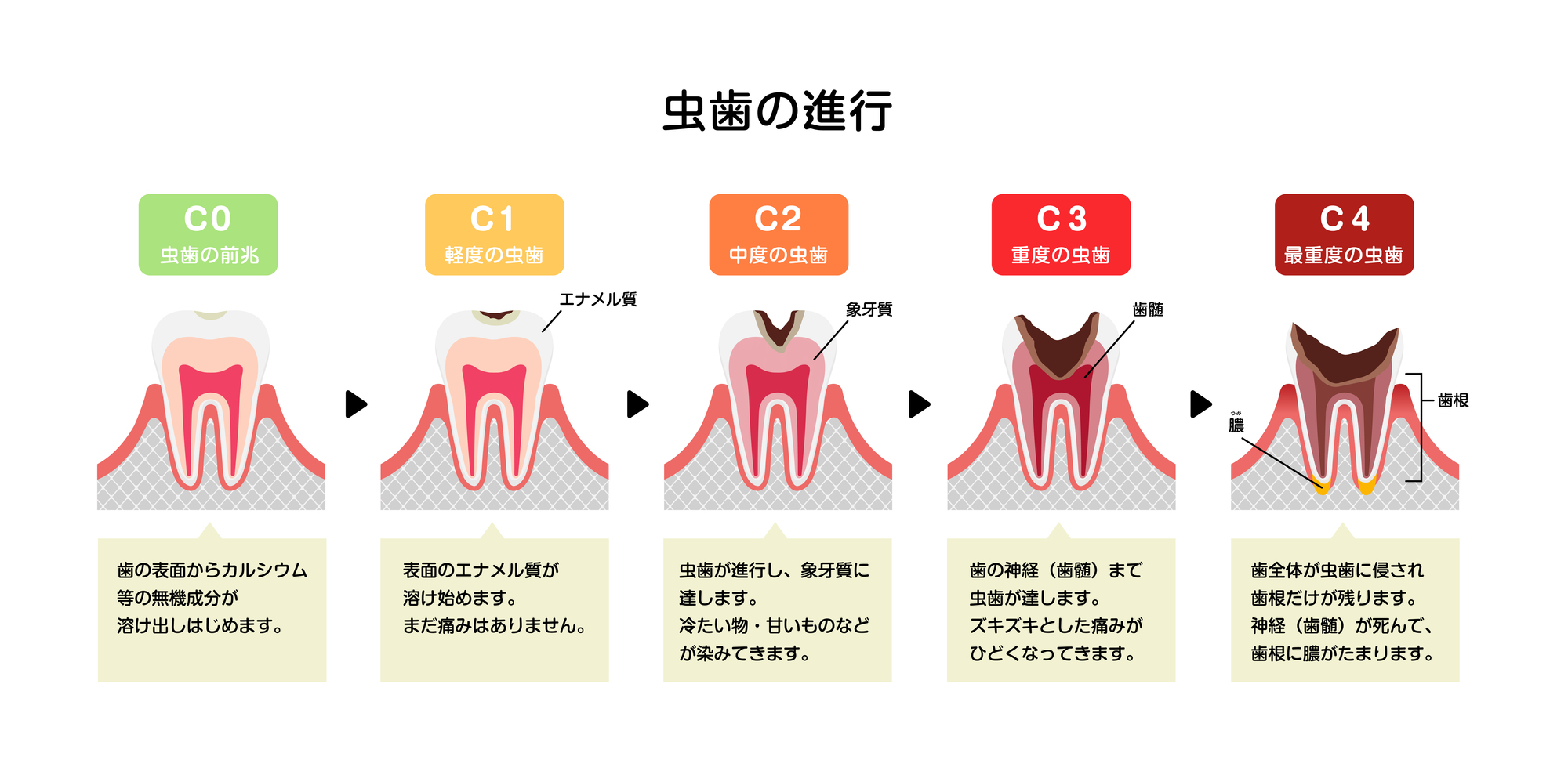 馬車道の歯医者 馬車道アイランドタワー歯科｜ブログ｜虫歯の早期発見で有効な治療コンポジットレジン修復について｜虫歯の進行段階の図