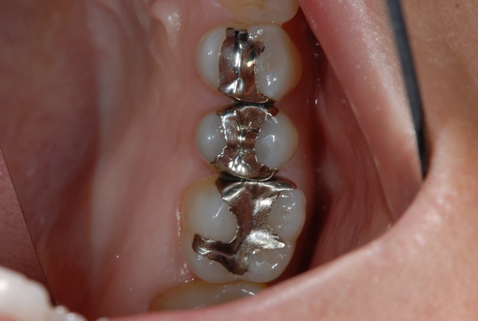 馬車道の歯医者 馬車道アイランドタワー歯科｜ブログ｜虫歯の早期発見で有効な治療コンポジットレジン修復について｜銀歯による虫歯治療の画像