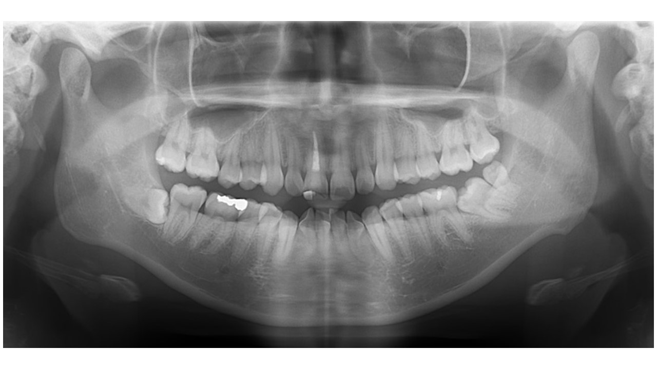 【症例】神経のない前歯の変色に対するジルコニアセラミックでの審美修復と破折リスクへの対応