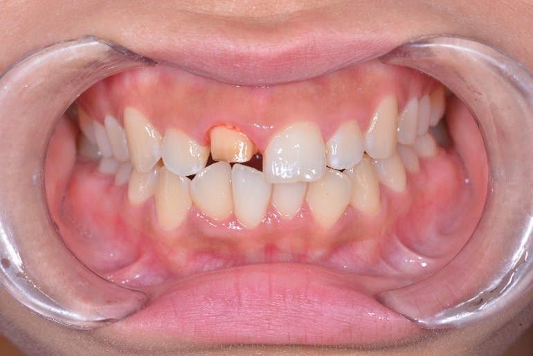 【症例】神経のない前歯の変色に対するジルコニアセラミックでの審美修復と破折リスクへの対応
