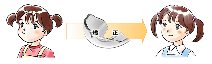 馬車道アイランドタワー歯科｜歯科医師ブログ｜子どもが受け口（反対咬合）かな？と思ったら・・・｜乳歯期の矯正歯科のイメージ