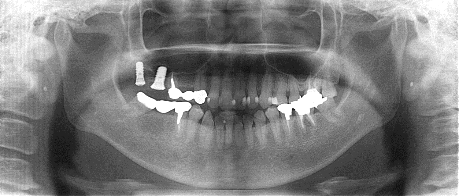 【症例】骨の高さが足りない場合のソケットリフト（上顎洞底挙上術）によるインプラント治療 インプラント埋入後のレントゲン画像｜馬車道の歯医者 馬車道アイランドタワー歯科