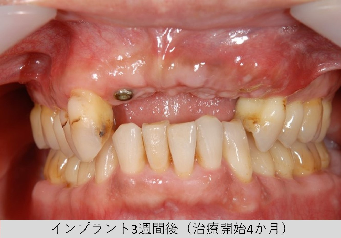 【症例】サージカルガイドを用いた前歯部インプラント（ガイデッドサージェリー）