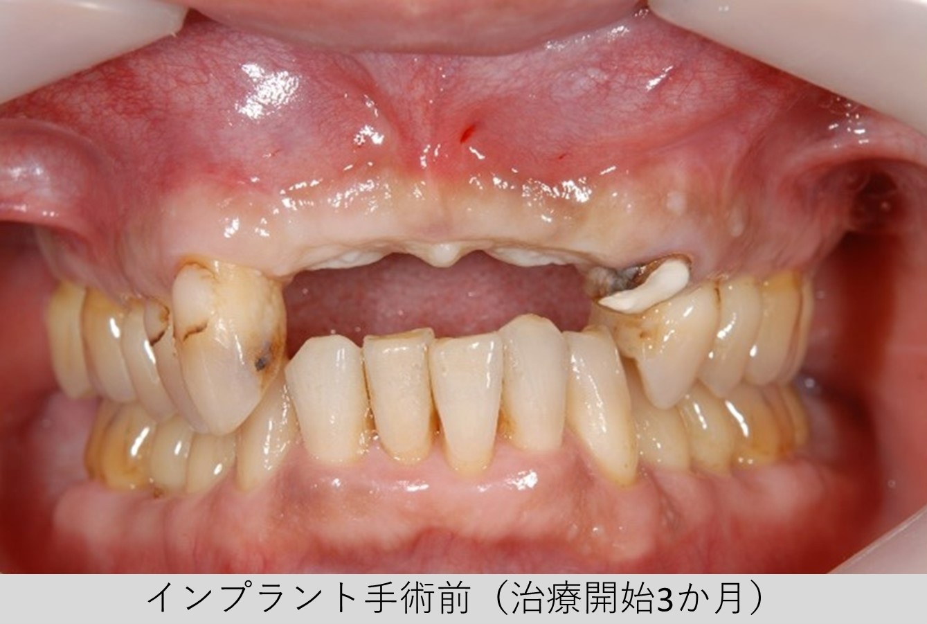 【症例】サージカルガイドを用いた前歯部インプラント（ガイデッドサージェリー）