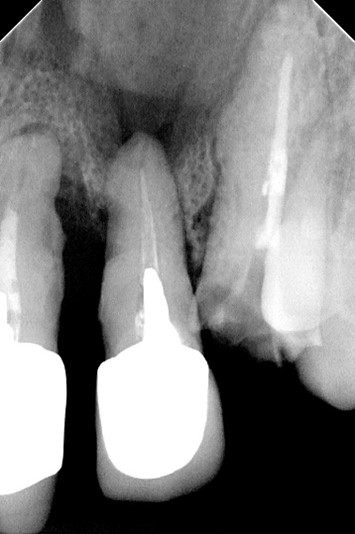 【症例】サージカルガイドを用いた前歯部インプラント（ガイデッドサージェリー）
