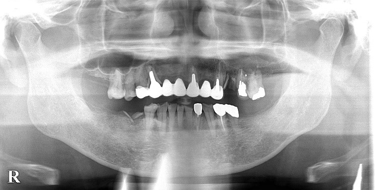【症例】インプラントを用いて噛み合わせを安定 ｜治療中レントゲン画像１｜馬車道の歯医者 馬車道アイランドタワー歯科