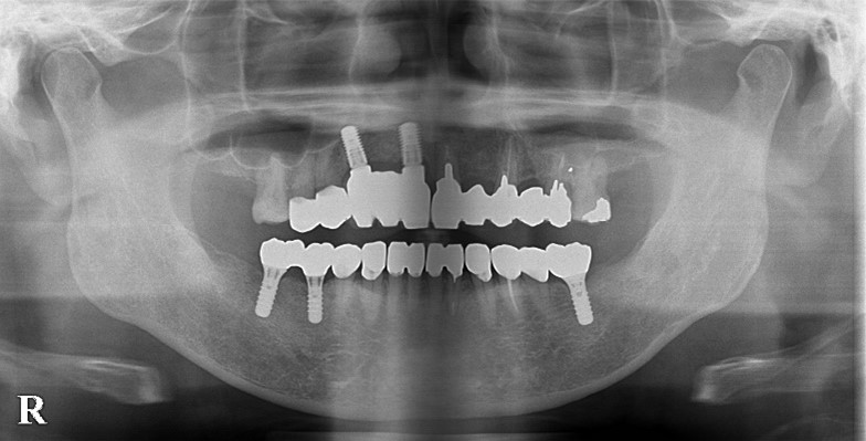 【症例】インプラントを用いて噛み合わせを安定 ｜治療中レントゲン画像２｜馬車道の歯医者 馬車道アイランドタワー歯科