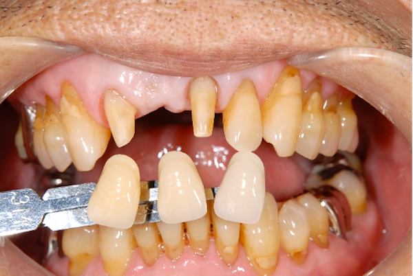 馬車道アイランドタワー歯科｜ブログ｜【症例】歯肉退縮をセラミックで再現し調和を図った審美治療｜口腔画像_治療詳細1