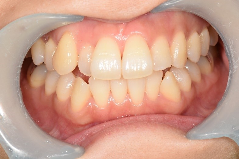 【症例】歯のクリーニング後さらに歯を白く-オフィスホワイトニング-