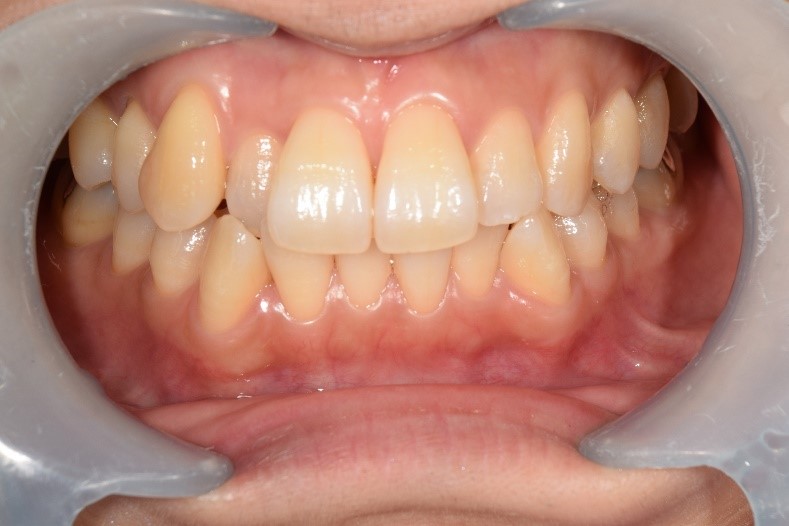 【症例】歯のクリーニング後さらに歯を白く-オフィスホワイトニング-