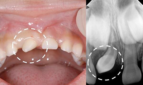 歯並びに影響を与える過剰歯とは？症例をもとに詳しく解説