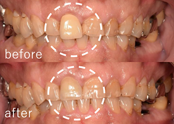 【症例】難しい色調再現が必要な差し歯の交換