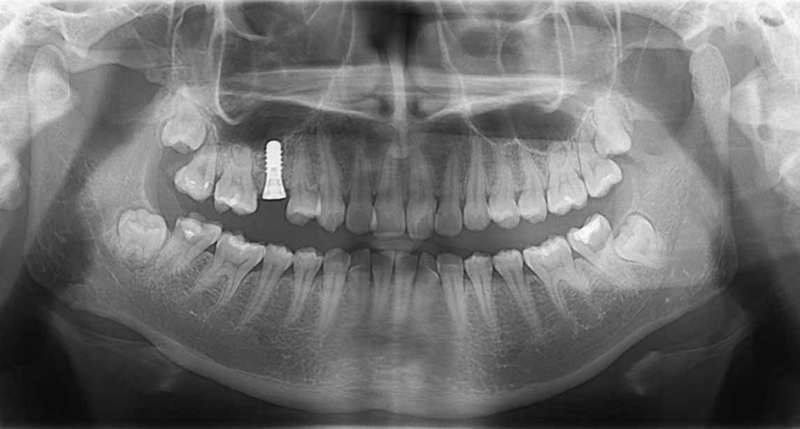 【症例】抜歯と同時にインプラントを行う、抜歯即時埋入インプラント｜馬車道の歯医者 馬車道アイランドタワー歯科｜インプラント埋入直後のレントゲン画像