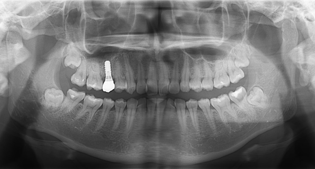 【症例】抜歯と同時にインプラントを行う、抜歯即時埋入インプラント｜馬車道の歯医者 馬車道アイランドタワー歯科｜被せ物装着後のレントゲン画像