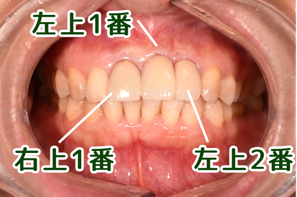 【症例】古いセラミックを現状と同じ形態・色調で交換