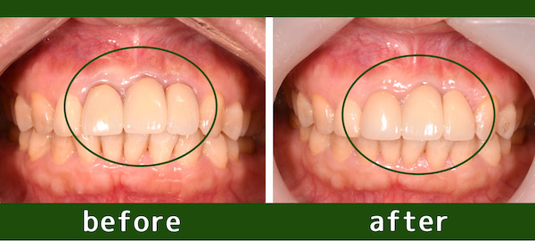 【症例】古いセラミックを現状と同じ形態・色調で交換