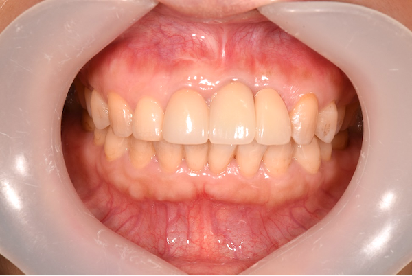 【症例】古いセラミックを現状と同じ形態・色調で交換
