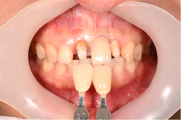 【症例】古いセラミックを現状と同じ形態・色調で交換