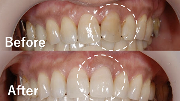 【症例】ホワイトニングとジルコニアセラミックを併用した前歯の審美治療