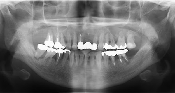 【症例】エムドゲインを用いた歯周組織再生療法