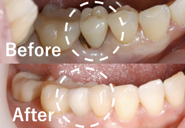 【症例】歯根破折した歯の抜歯後のインプラント治療