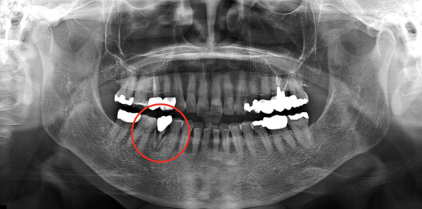 馬車道アイランドタワー歯科｜【症例】歯根破折した歯の抜歯後のインプラント治療｜治療前のレントゲン