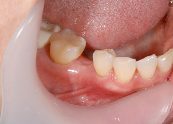 馬車道アイランドタワー歯科｜【症例】歯根破折した歯の抜歯後のインプラント治療｜抜歯後