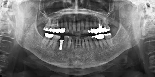 馬車道アイランドタワー歯科｜【症例】歯根破折した歯の抜歯後のインプラント治療｜埋入後レントゲン
