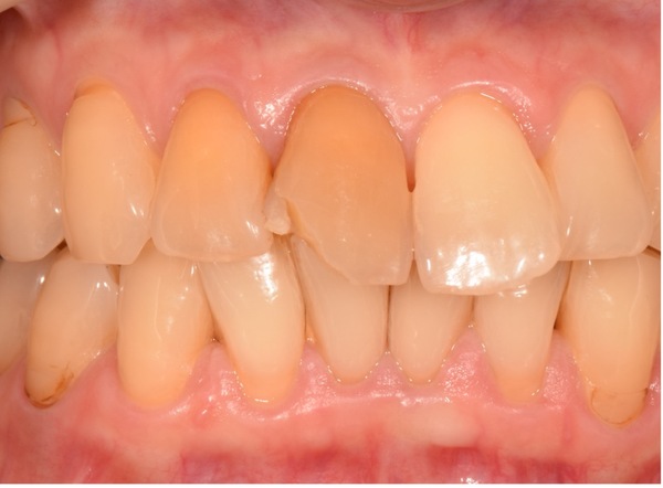 馬車道アイランドタワー歯科｜【症例】ぶつけて破損してしまった歯に対して行ったセラミックによる審美治療｜治療前2